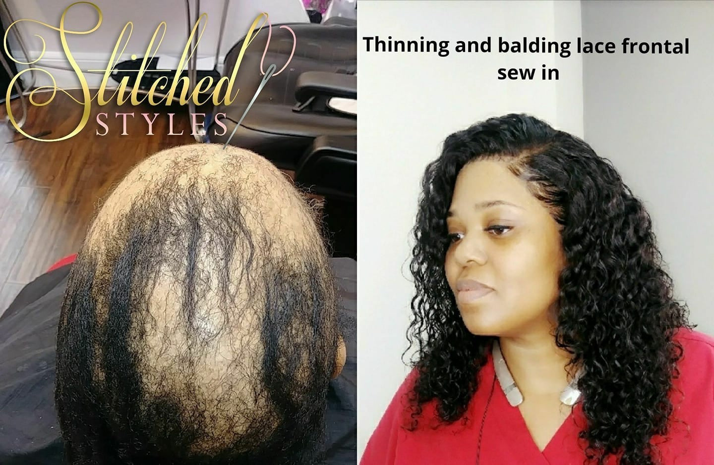 Sewin for thinning and balding